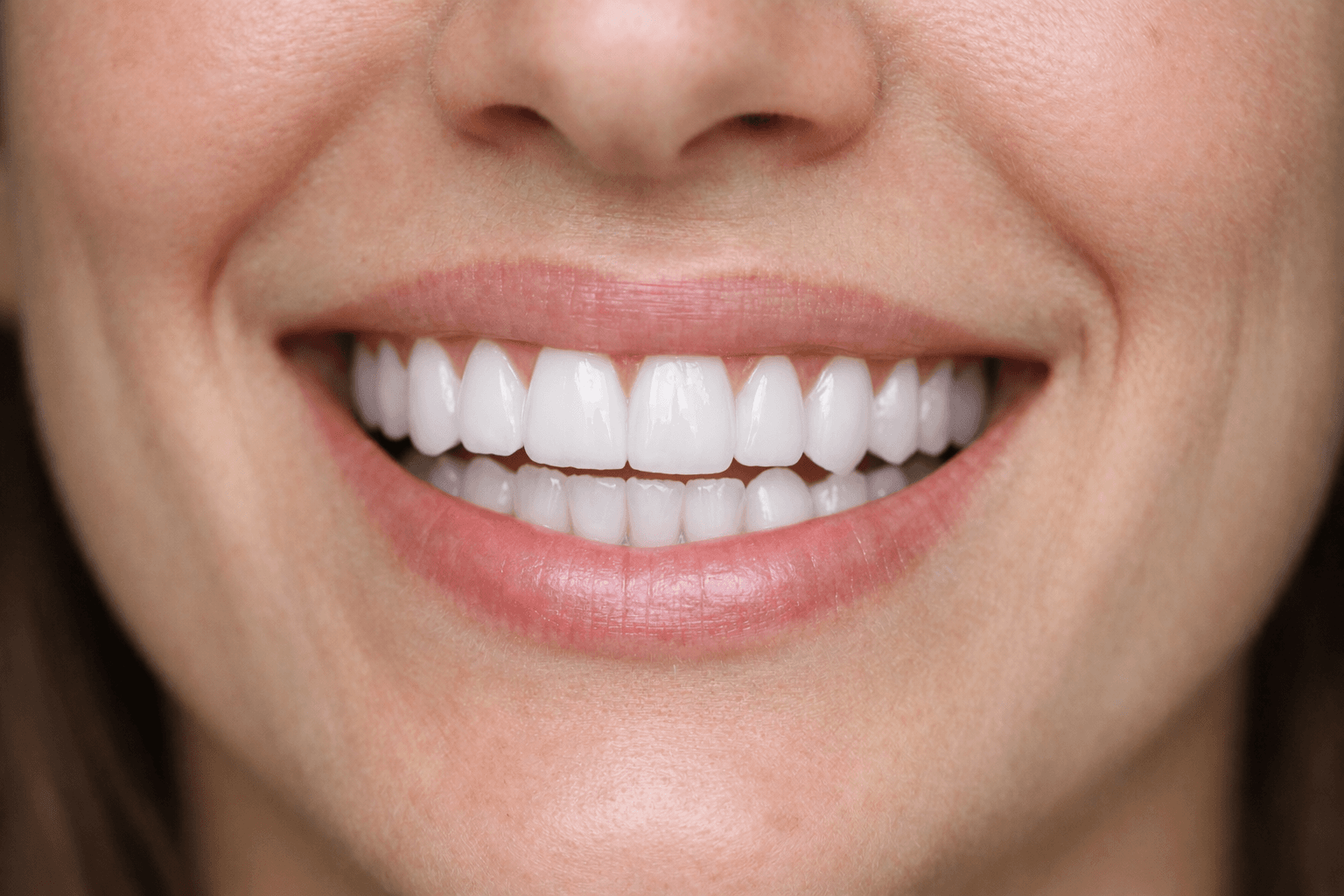 Lentes de Contato Dental - Depois