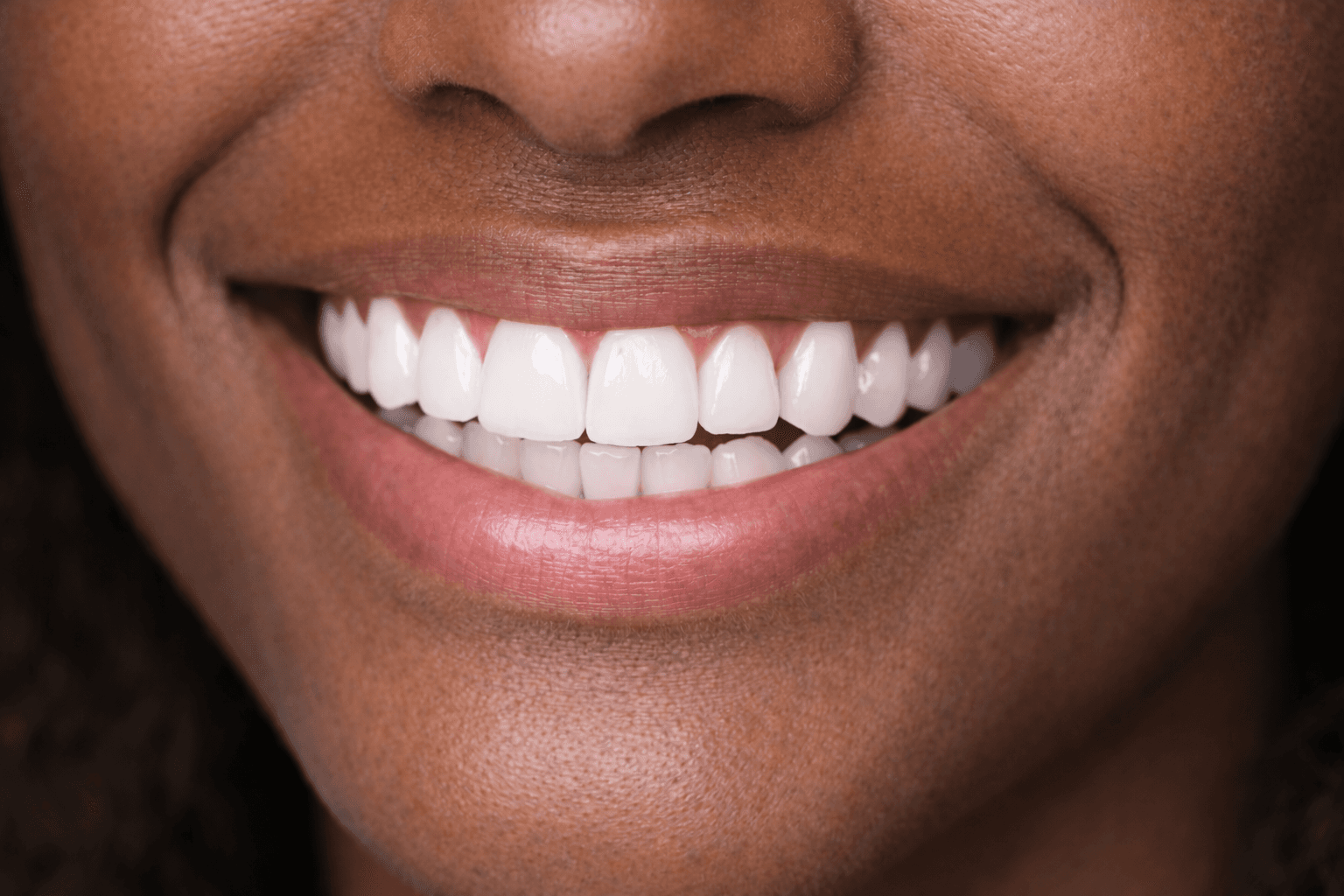 Facetas de Porcelana - Depois