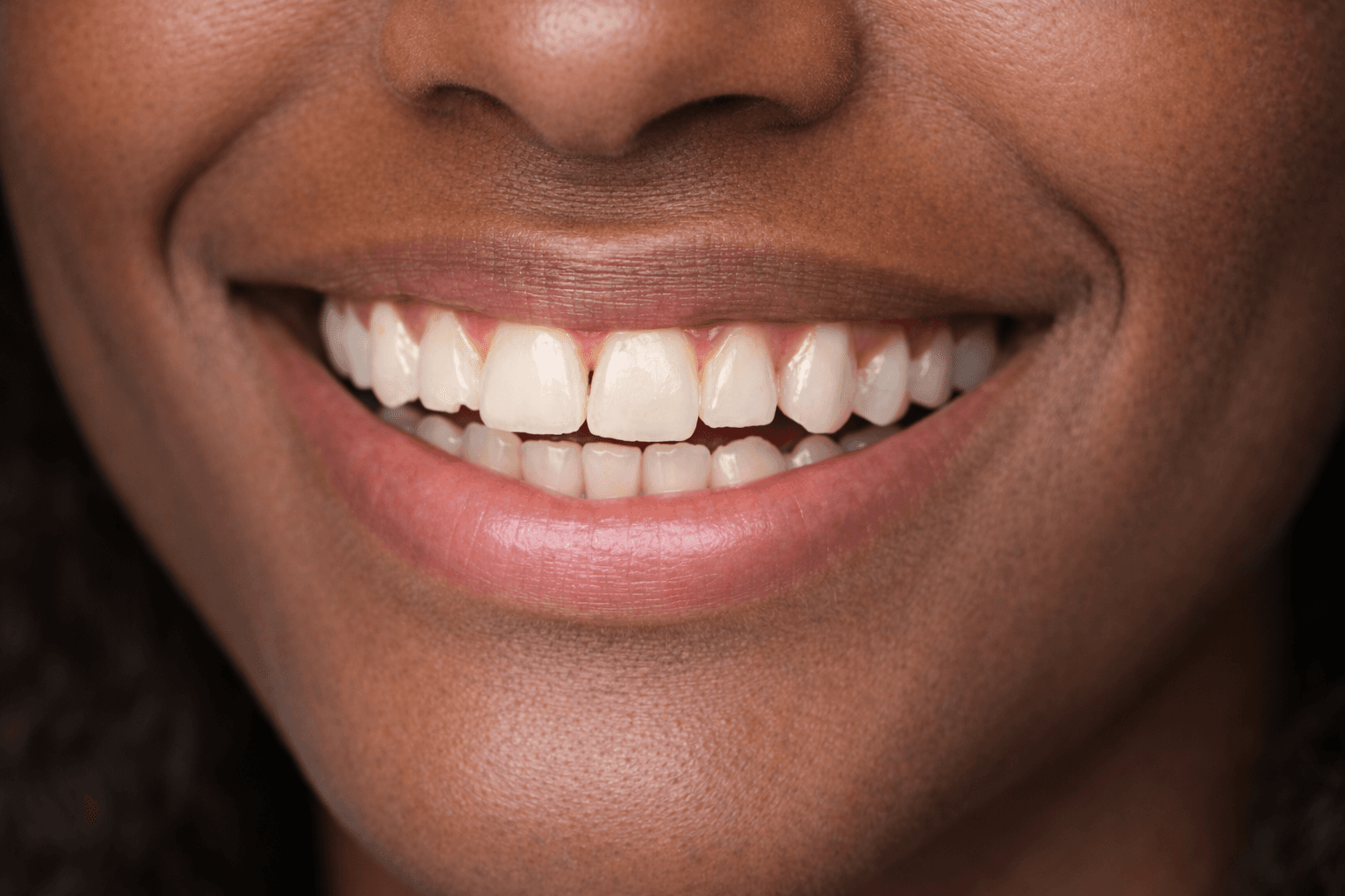 Facetas de Porcelana - Antes